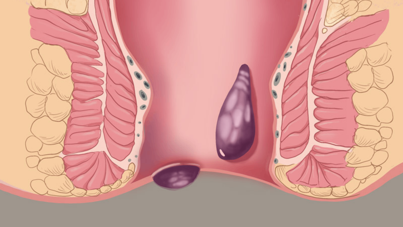 Ilustração médica educativa das hemorroidas
